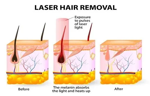 Choosing a Reputable Clinic for Affordable Laser Hair Removal in India